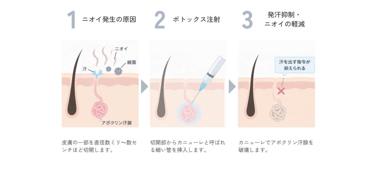 スソワキガ治療