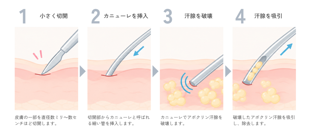 スソワキガ治療