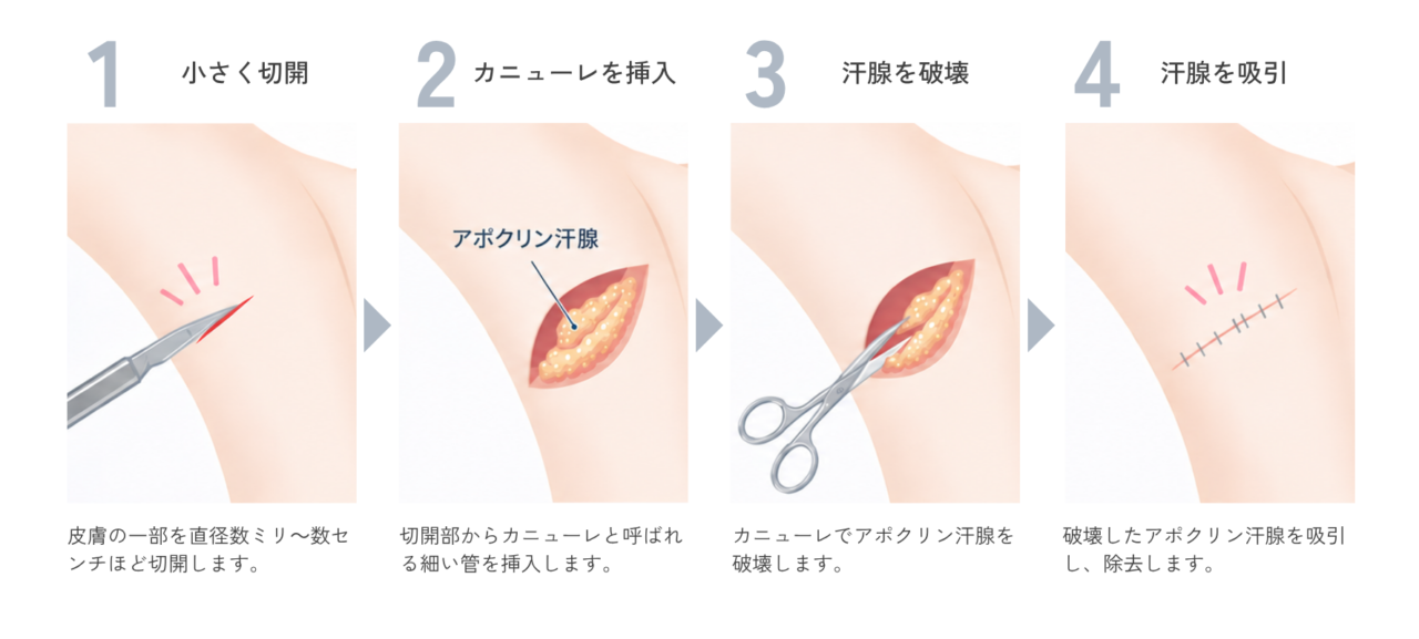 スソワキガ治療