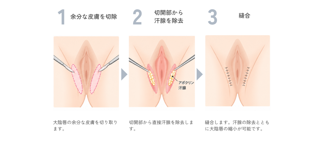 スソワキガ治療