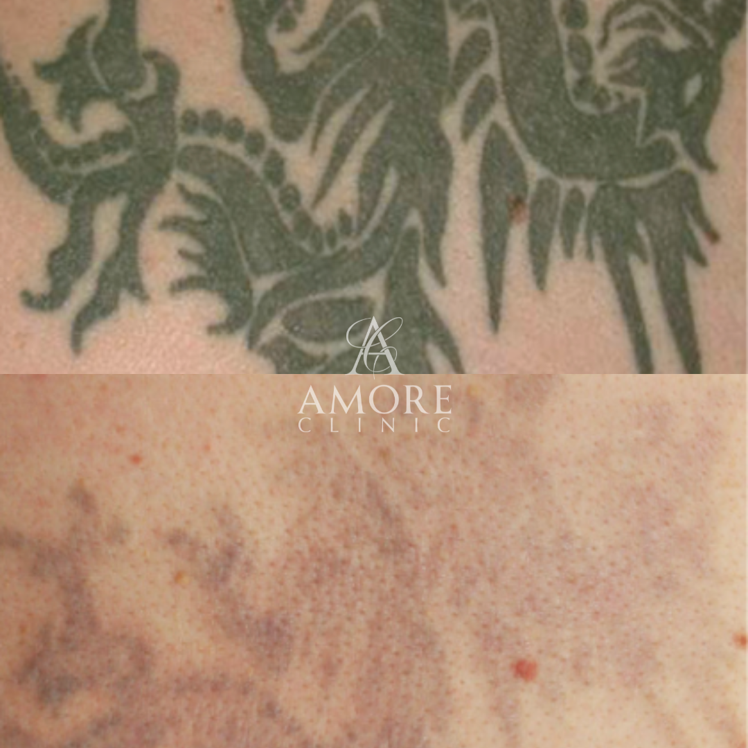 タトゥー除去（レーザー）