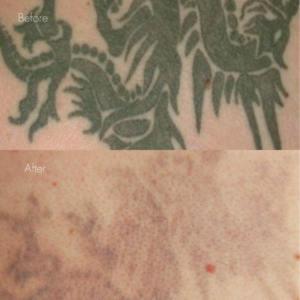 タトゥー除去（レーザー）