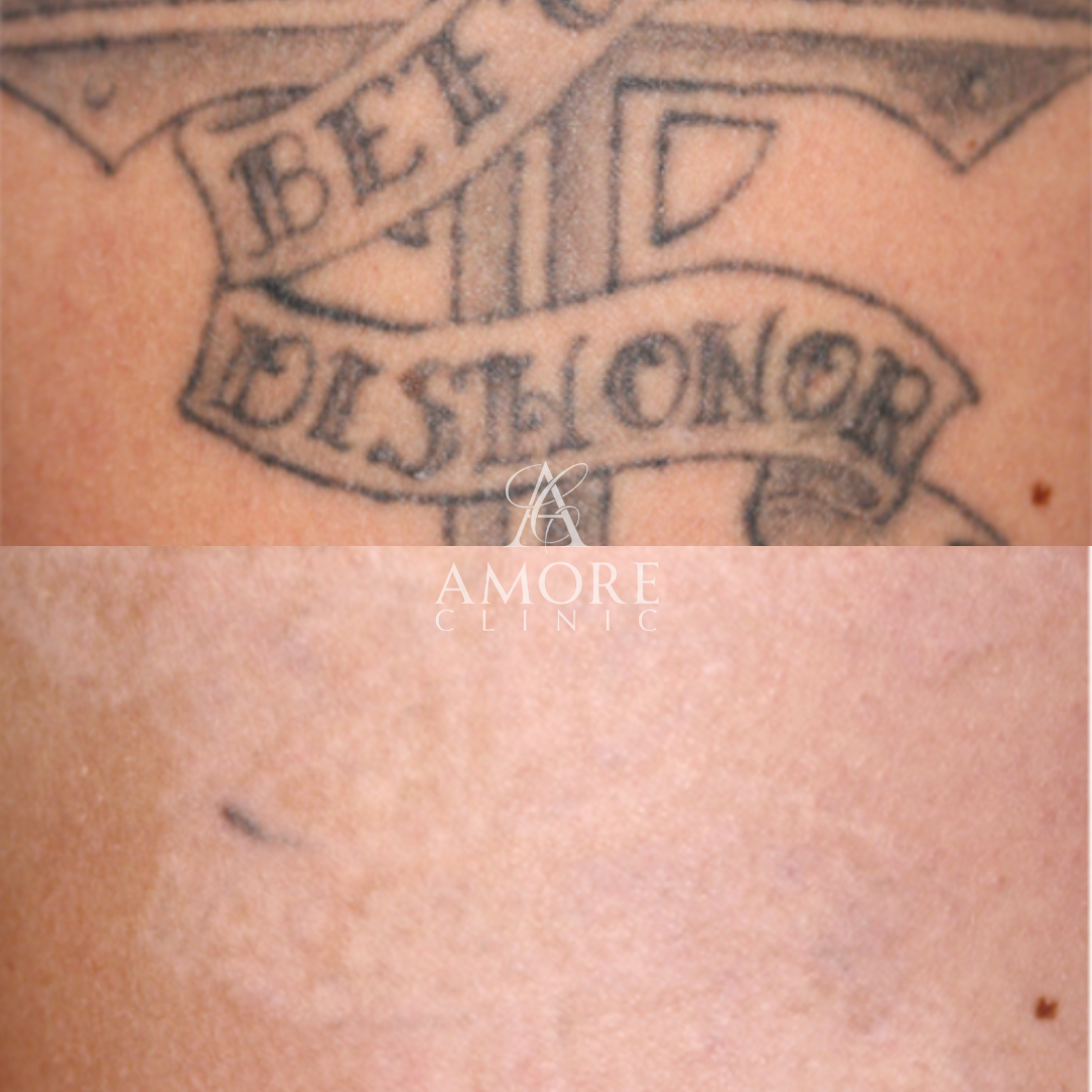 タトゥー除去（レーザー）