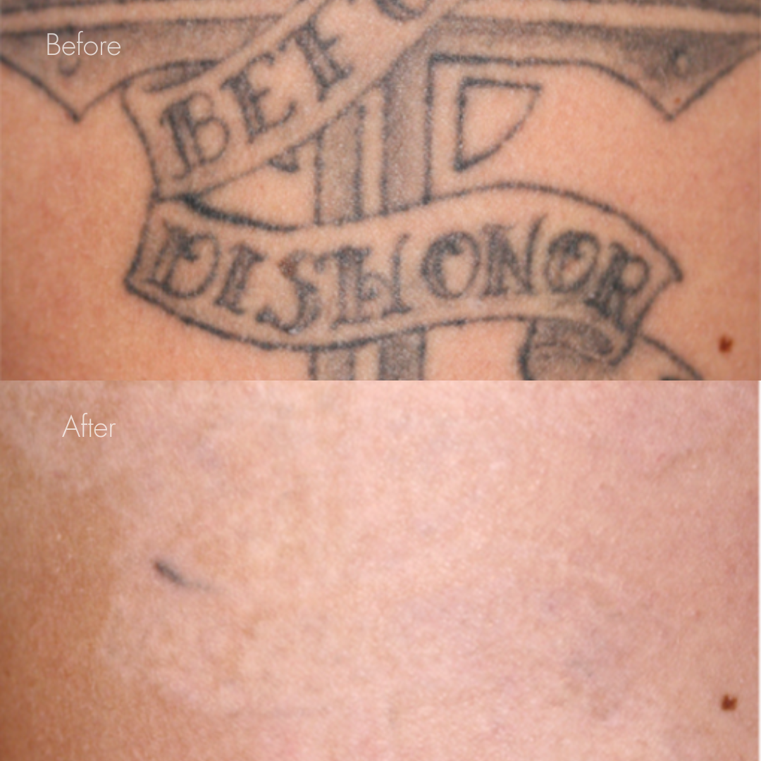 タトゥー除去（レーザー）