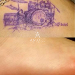 タトゥー除去（レーザー）