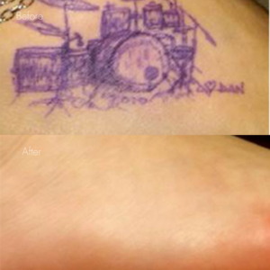 タトゥー除去（レーザー）