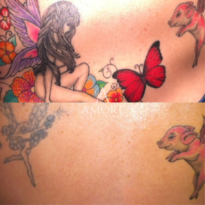 タトゥー除去（レーザー）