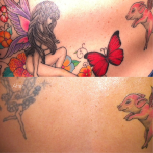 タトゥー除去（レーザー）