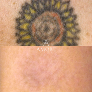 タトゥー除去（レーザー）