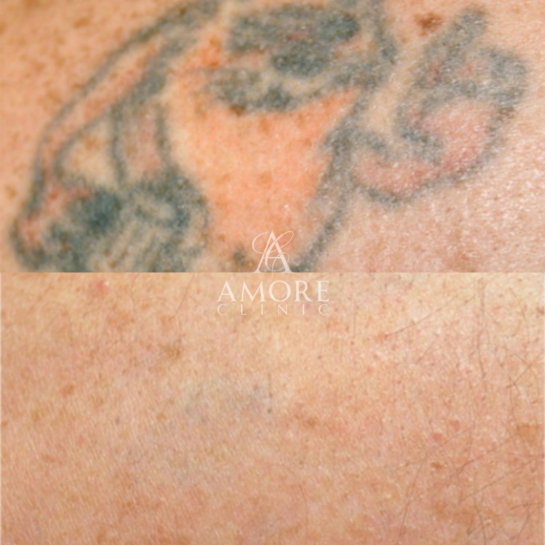 タトゥー除去（レーザー）