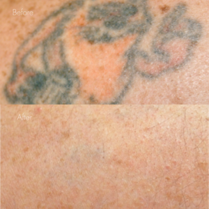 タトゥー除去（レーザー）