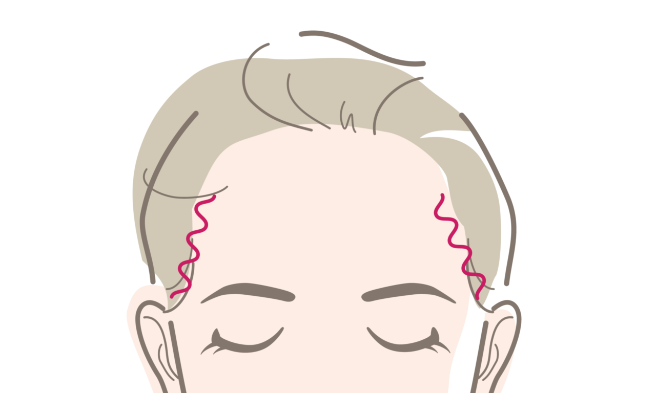 こめかみ縮小