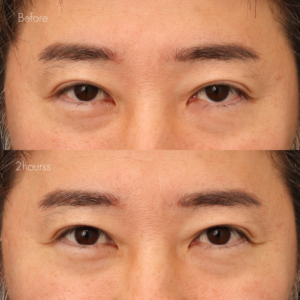 後天性眼瞼下垂点眼薬アップニーク
