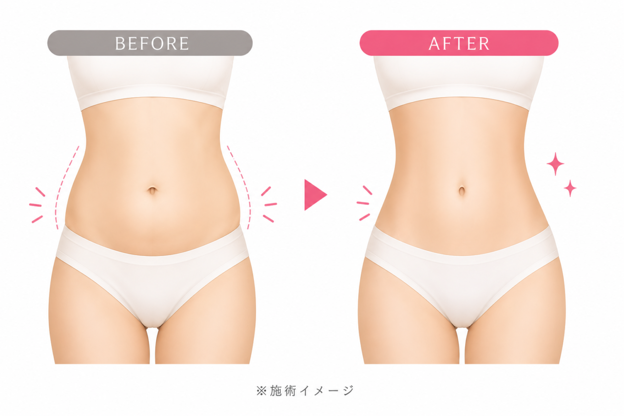 ベイザー脂肪吸引