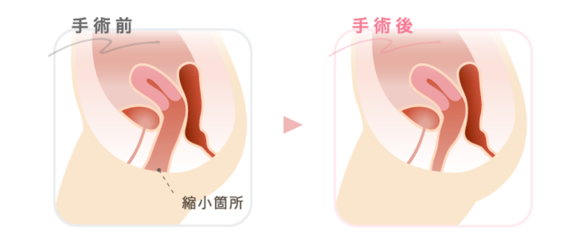 膣縮小