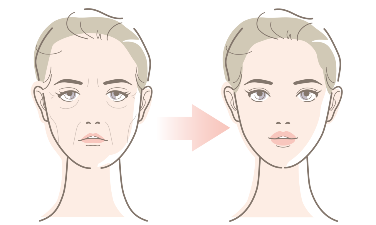 オーダーメイドヒアルリフト