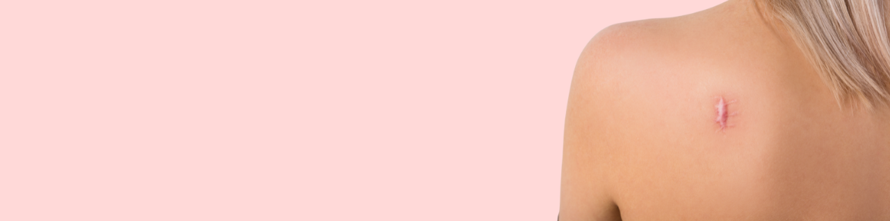 傷跡修正・タトゥー除去