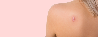 ケナコルト注射（ステロイド注射）