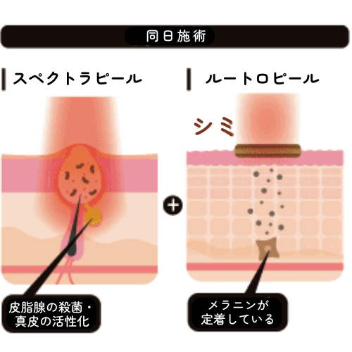 ※大阪院のみ※ハリウッドスペクトラ