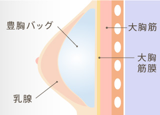 シリコンバッグ豊胸