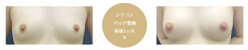 シリコンバッグ豊胸