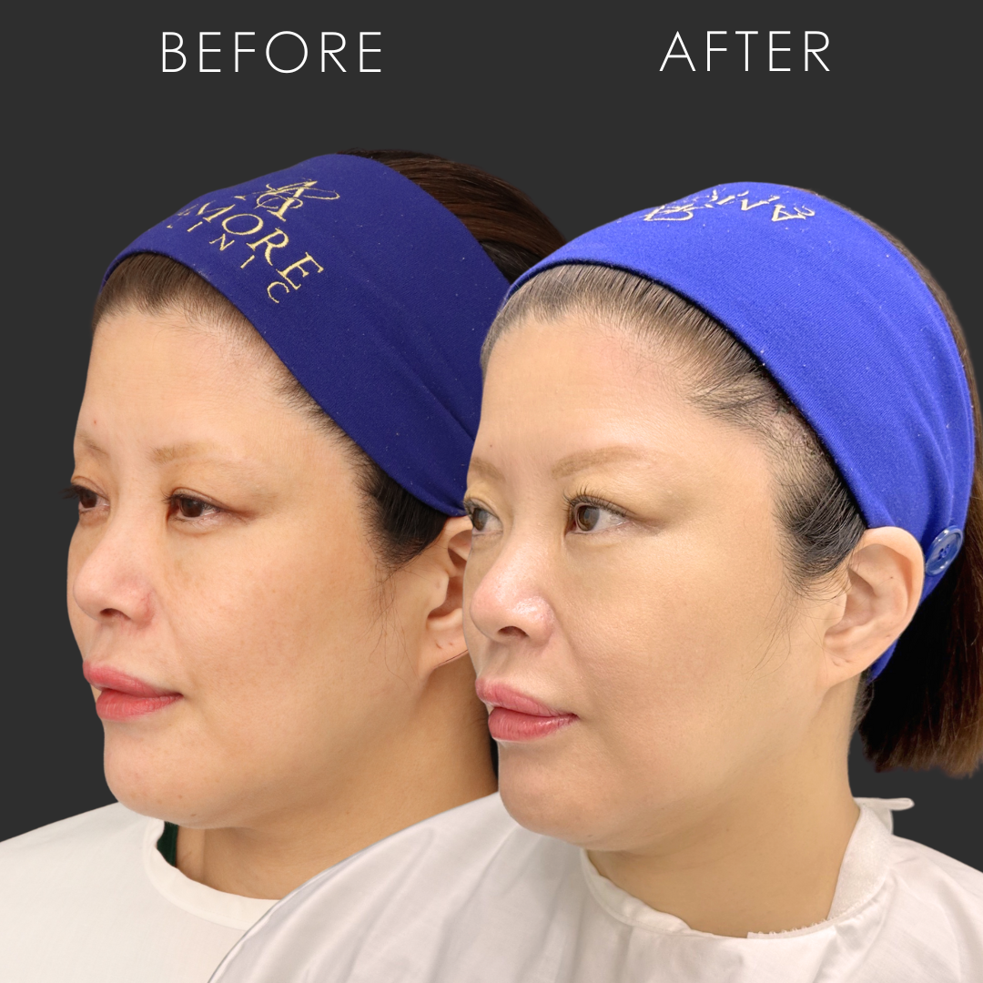 ポニーテールリフト