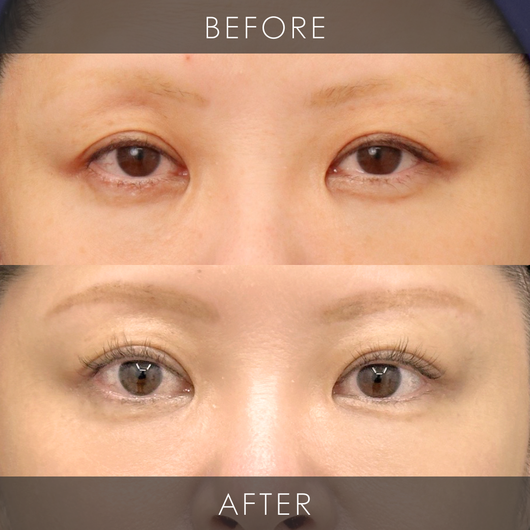 ポニーテールリフト