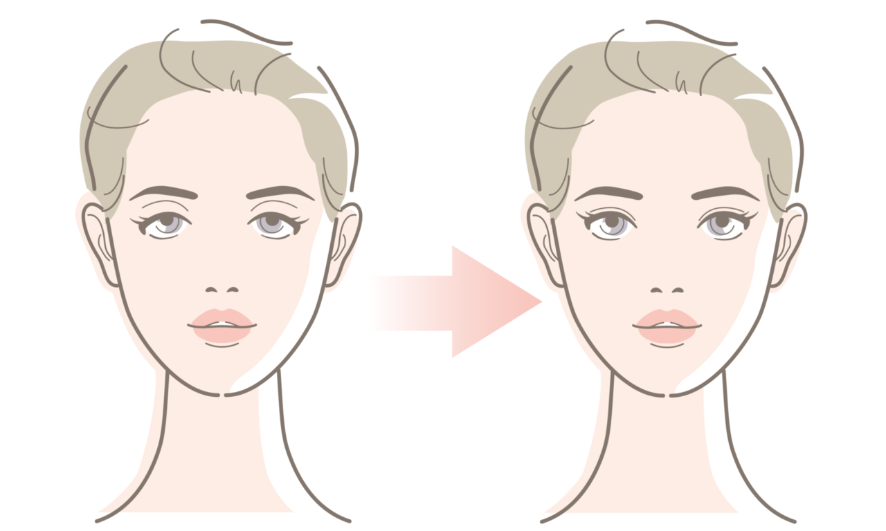 眉上切開・眉下切開