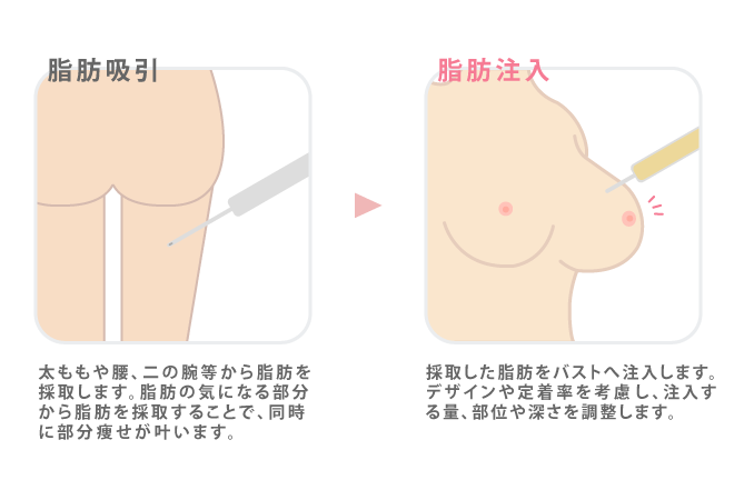 CRF脂肪注入豊胸